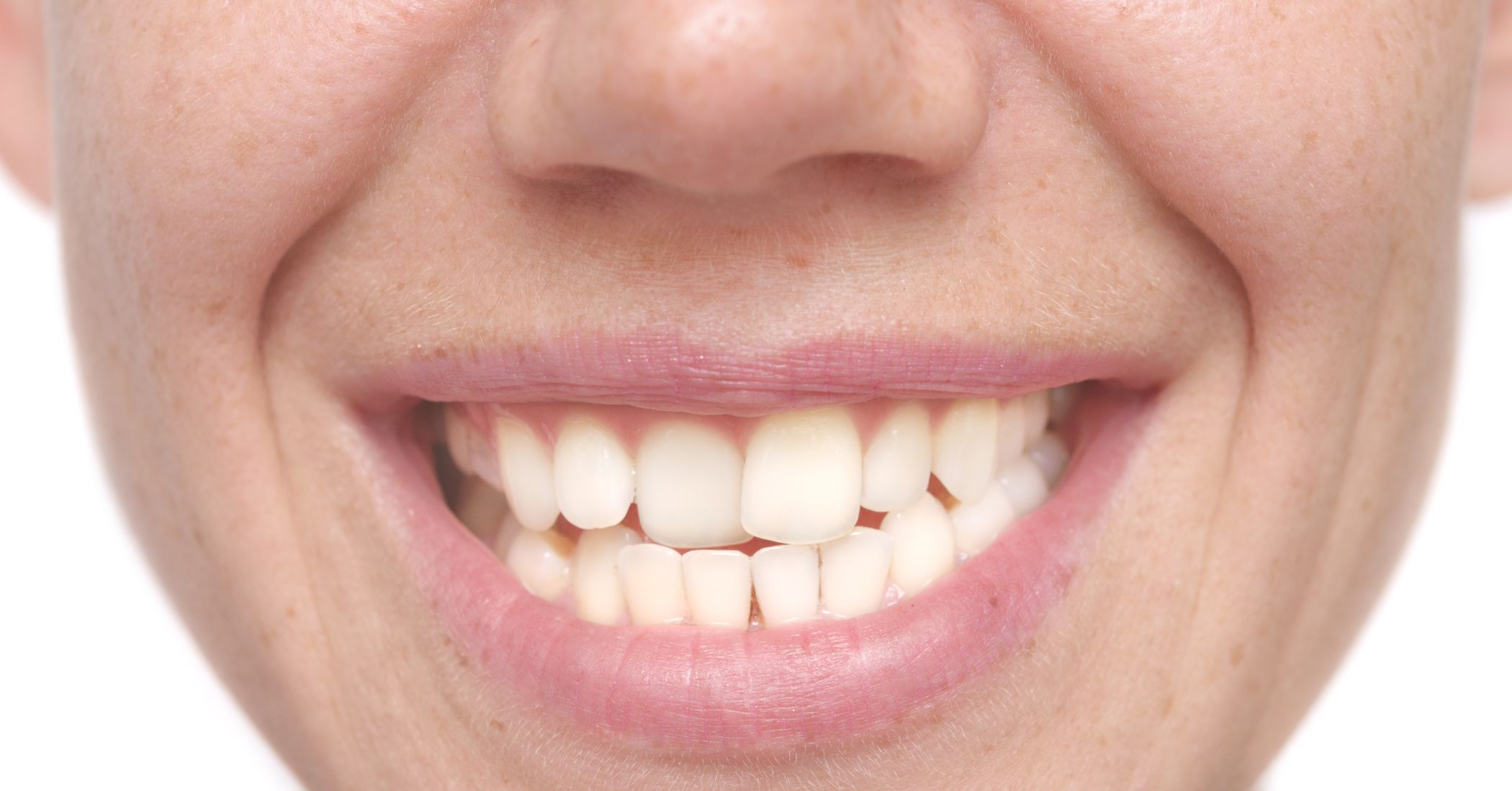 cover malocclusione dentale