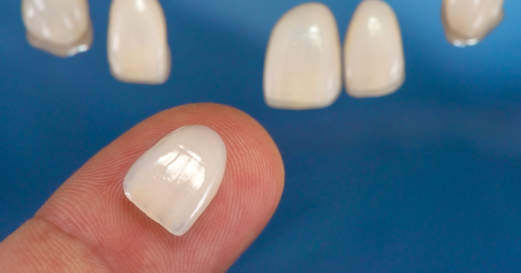 particolare di una faccetta dentale
