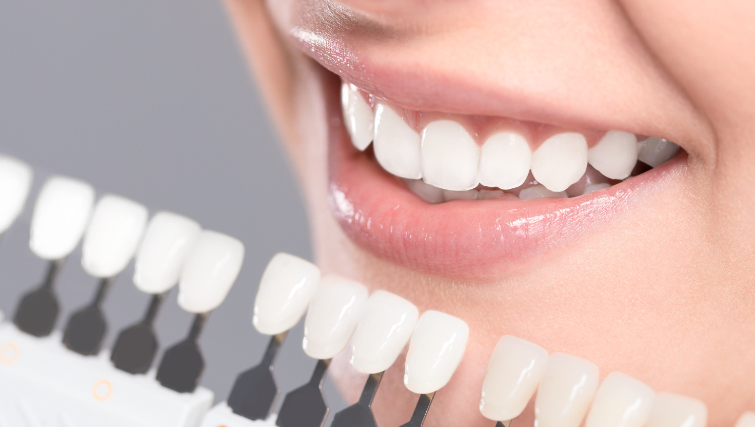 Cover sbiancamento dentale