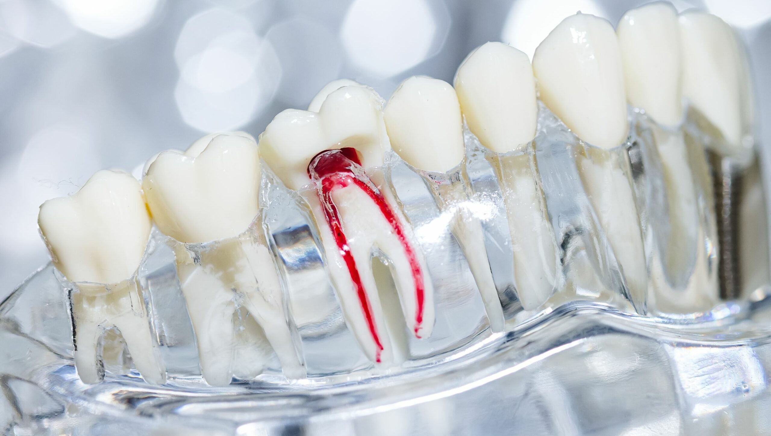 cover devitalizzazione dente