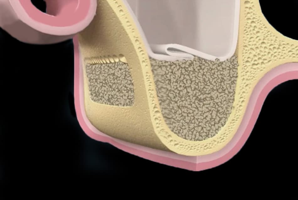 riempimento con osso