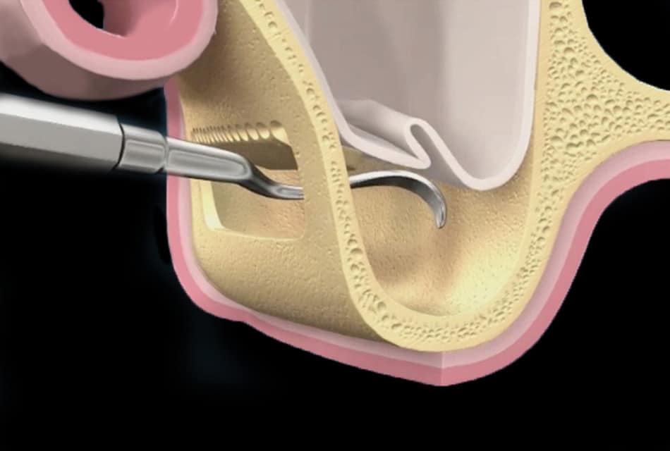 sollevamento membrana