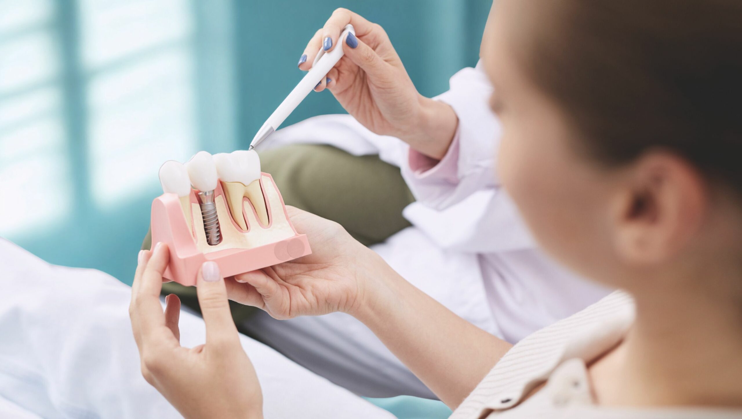 cover impianti dentali