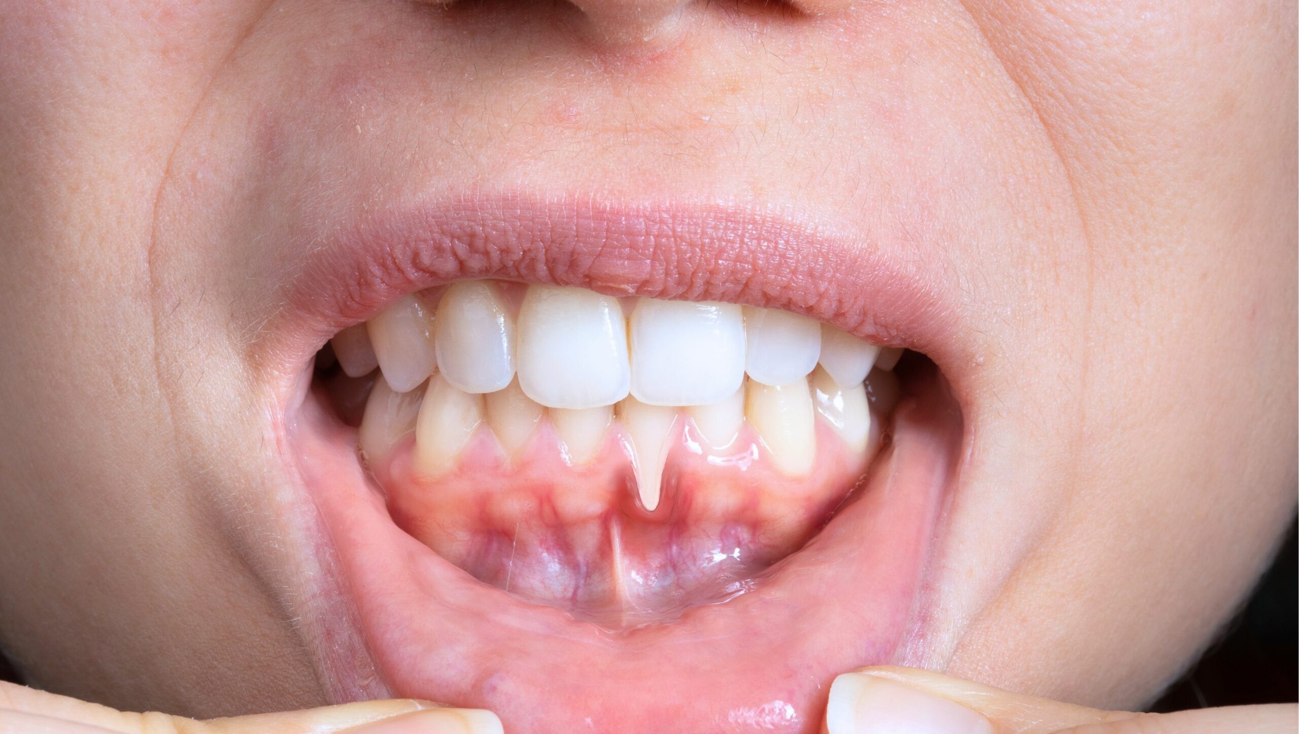 cover recessione gengivale